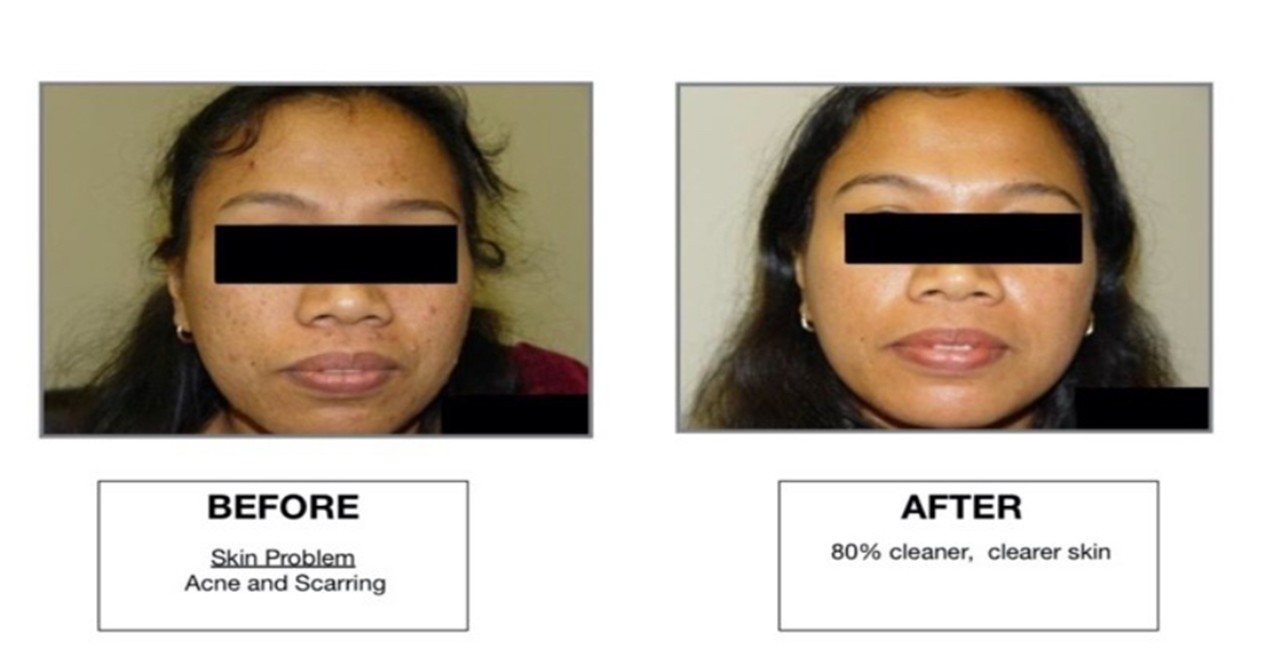 Deluxe Clinical Peel Treatment