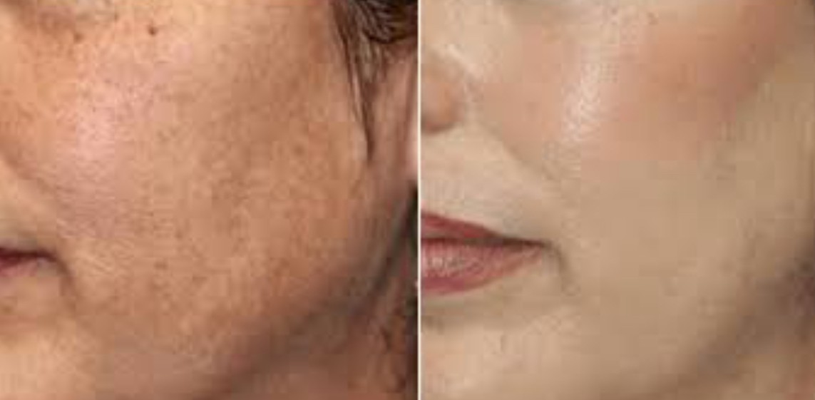 Laser Skin Rejuvenation Treatment