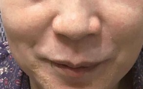 Cosmelan Peel Treatment