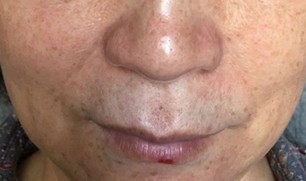 Cosmelan Peel Application Process