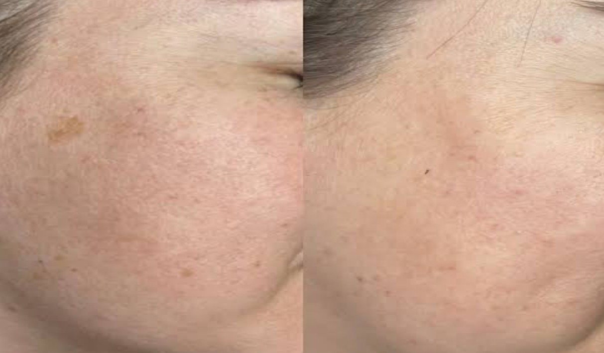 Pigmentation and Sunspot Removal Results