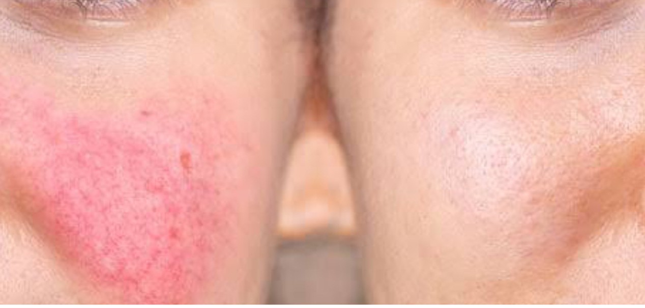 Redness and Rosacea Laser Treatment Results