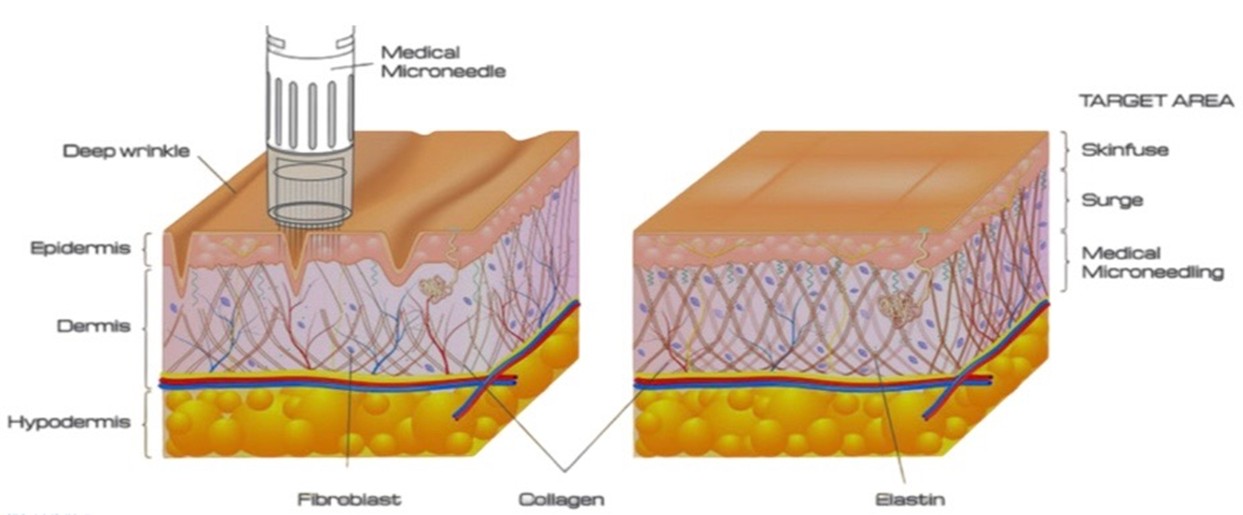 Advanced Skin Needling Treatment