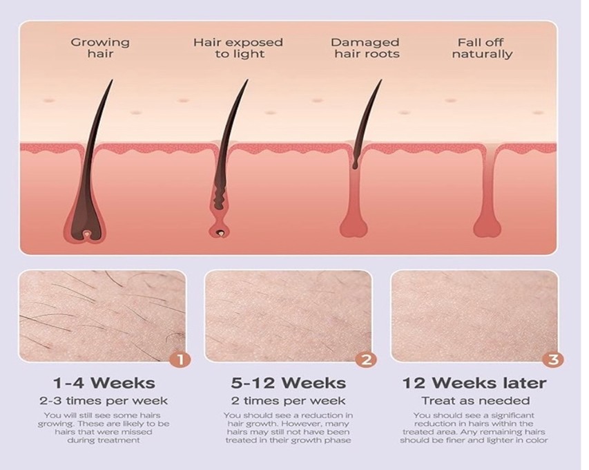 Diode Laser Hair Removal Treatment