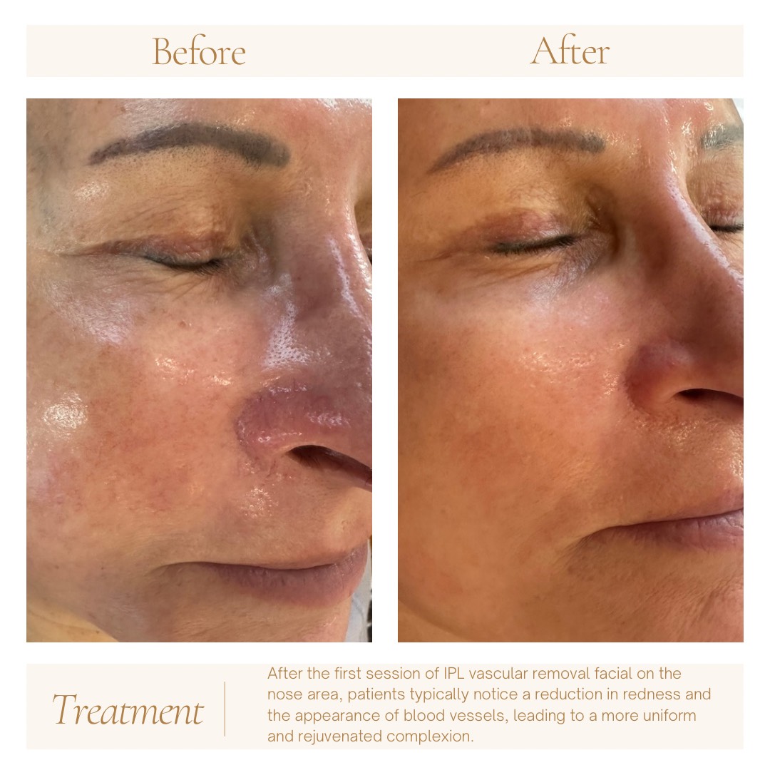 Before and after results